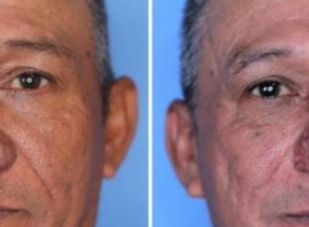 Homem  com o nariz mais estranho do mundo é presenteado com cirugia e sua vida muda totalmente